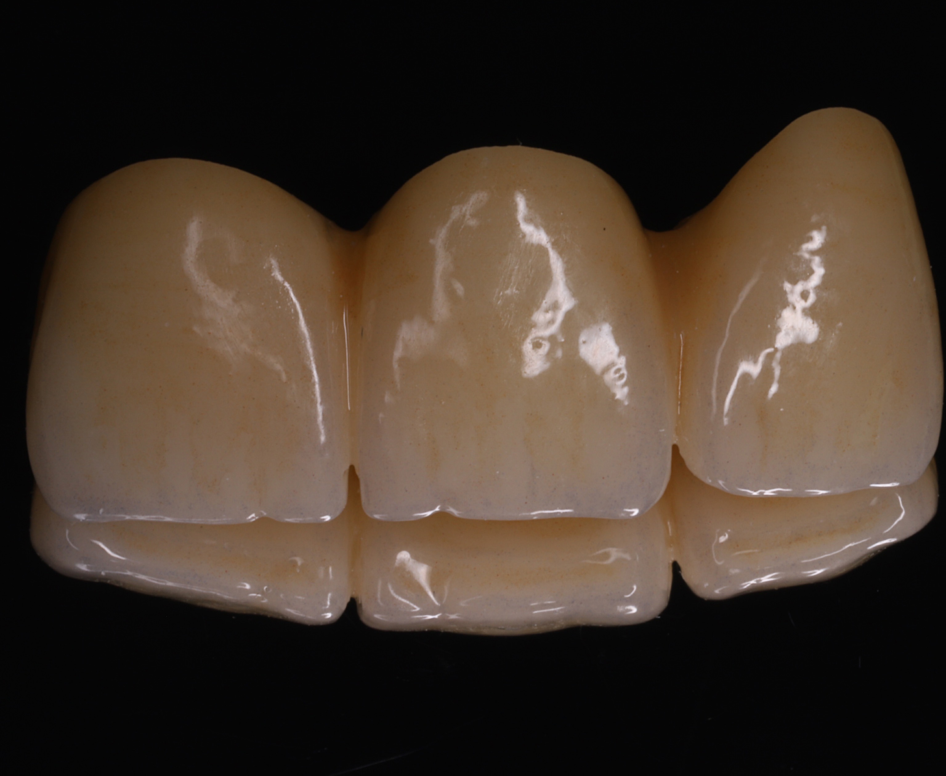 Установка циркониевого мостовидного протеза на передние зубы.