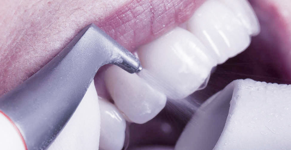Чистка эмали зубов, отбеливающая процедура (Air Flow)