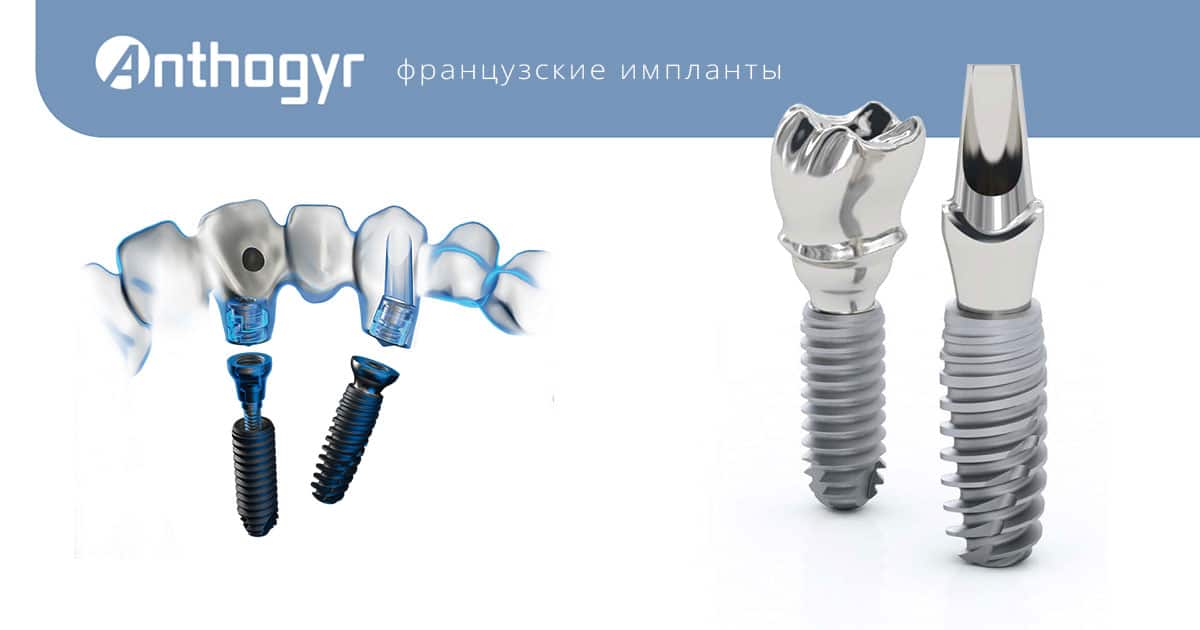 Импланты Anthogyr Томск Корейский стоматология суворова 12 томск