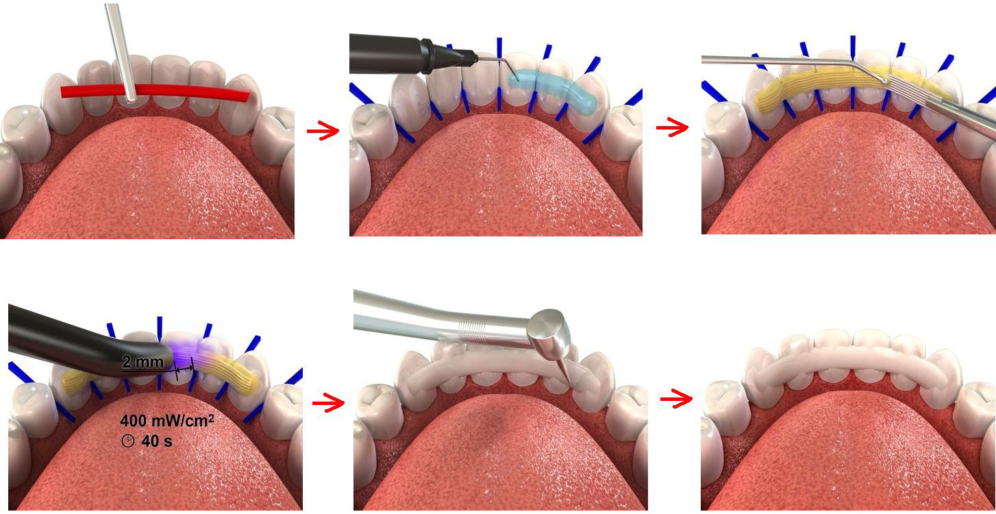 Лечение подвижных зубов в том числе шинирование