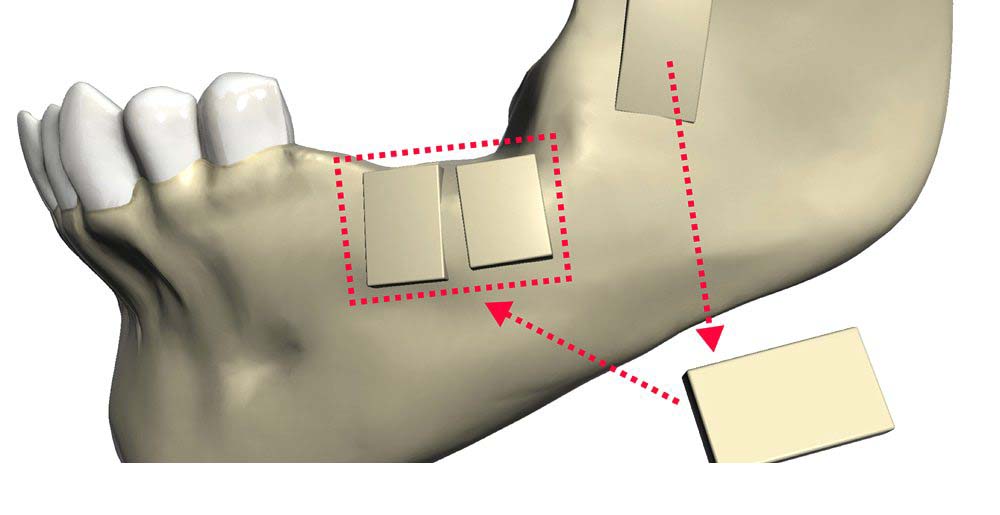 Пересадка костных блоков ( с ветви нижней челюсти и подборочного симфиза)