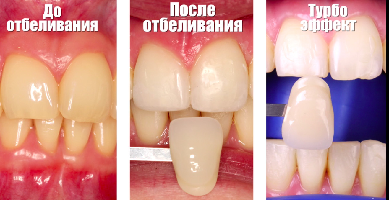 Klox (клокс) отбеливание зубов