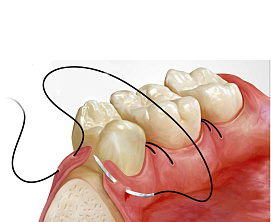 Пересадка десны (восстановление мягких тканей вокруг имплантов и зубов, пересадка сст, сдт, тоннельная пластика)