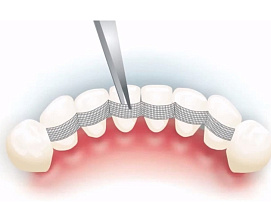 Лечение подвижных зубов в том числе шинирование