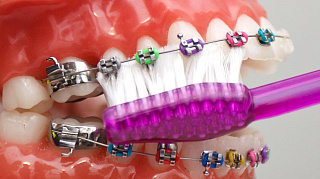 Комплексная чистка зубов с брекетами